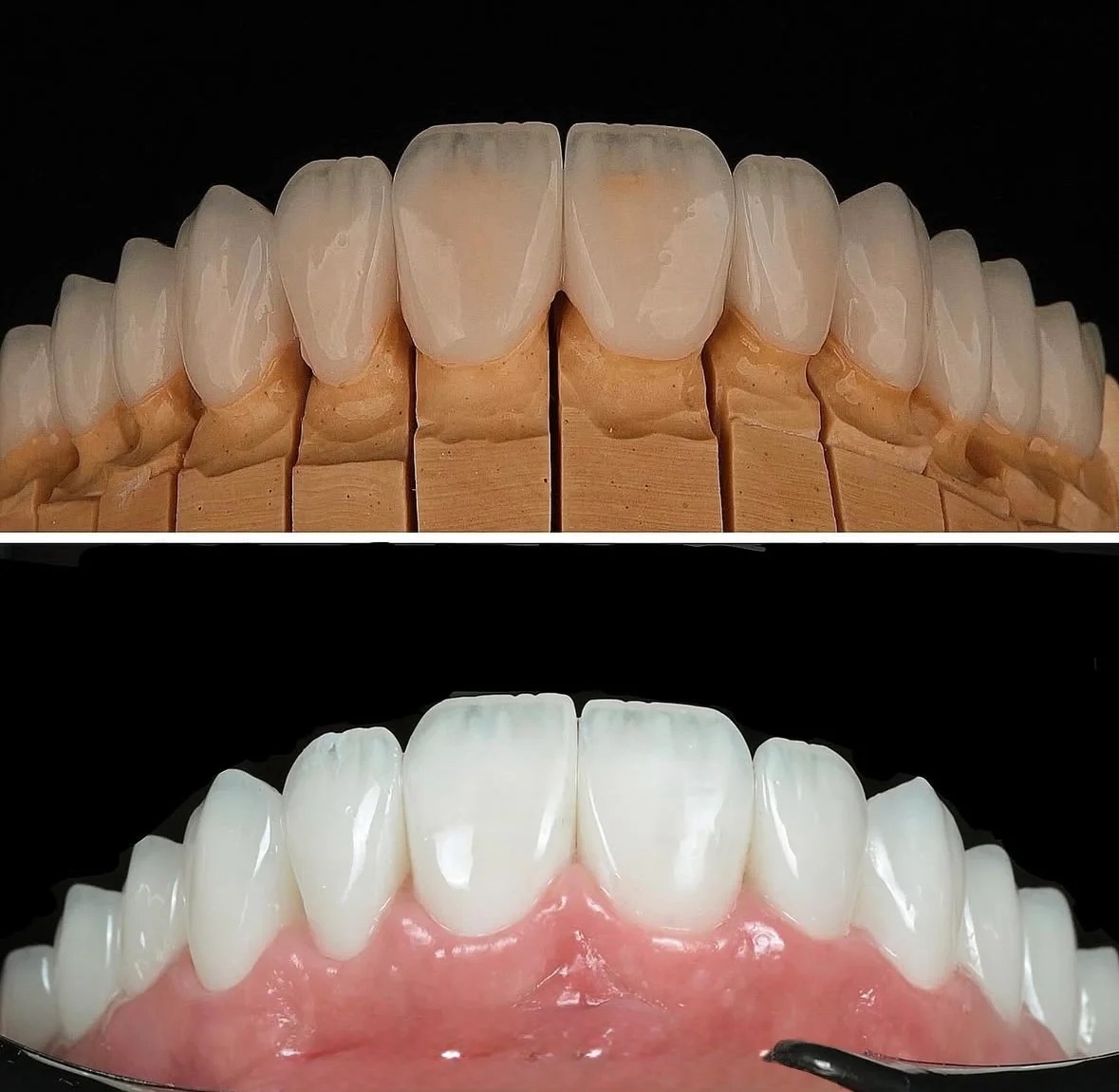 After treatment: custom ceramic restorations designed with meticulous attention to the micro-details of tooth anatomy, including natural surface texture, ideal incisal translucency, and proper embrasure spaces.